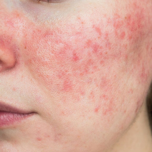 Rosacea Awareness Month - Top Tips