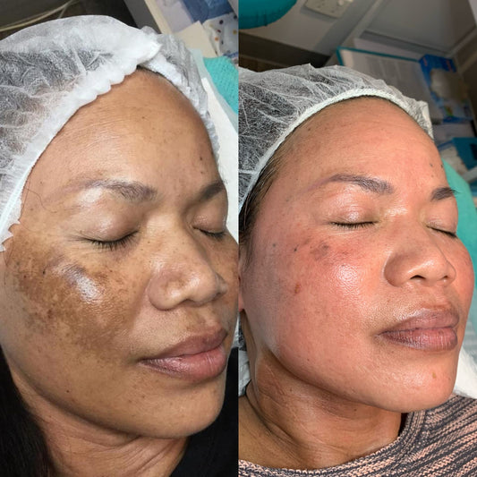 Pigmentation Doesn’t Stand a Chance: Why Cosmelan Is THAT Treatment