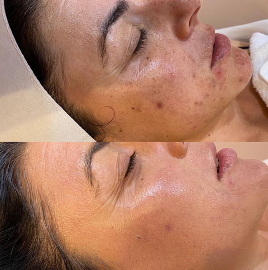 Dermapen 4™ Microneedling - The Future of Skin