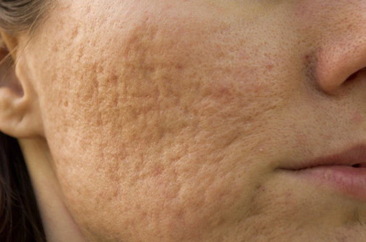 Not All Acne Scars Are the Same – Here’s What You Need to Know