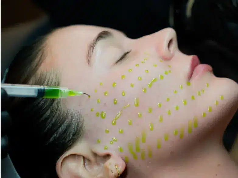 BioRePeelCl3 Chemical Peel