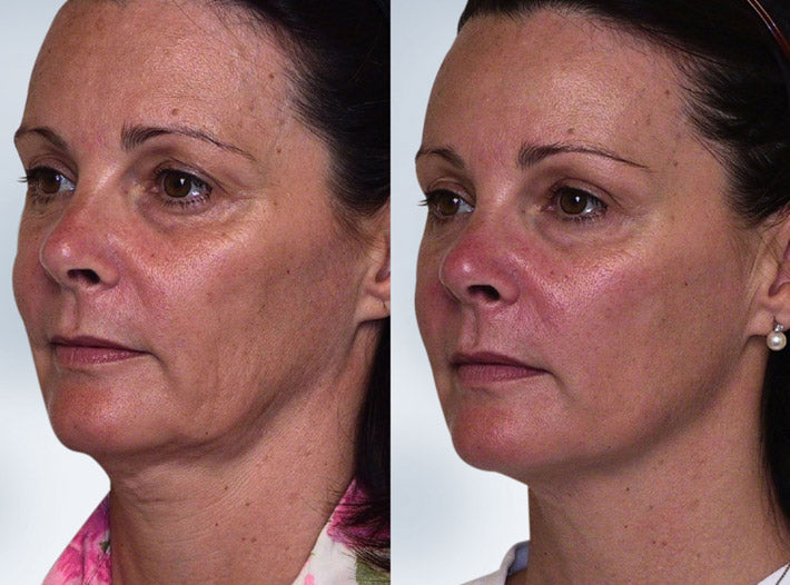 Sculptra® Biostimulator