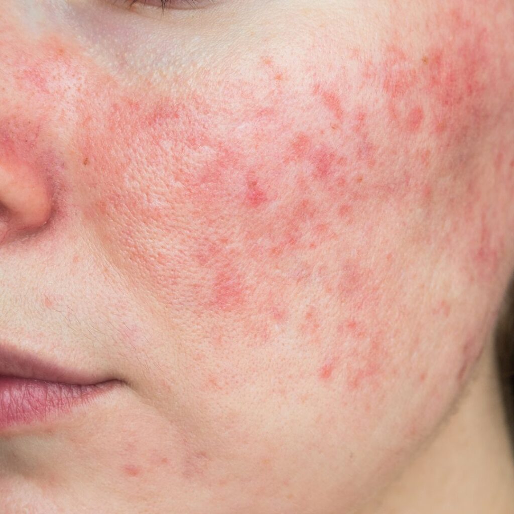 Rosacea Awareness Month: Top Tips