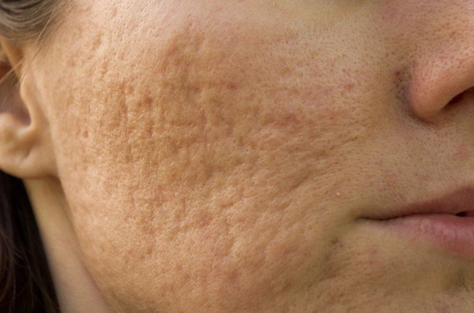 Not All Acne Scars Are the Same – Here’s What You Need to Know