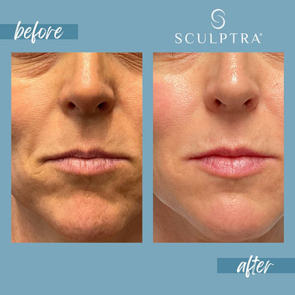 Sculptra® Biostimulator